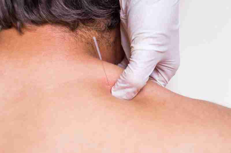 Dry Needling - Ascent Physical Therapy & Performance